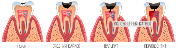 Стоимость лечения зуба воронеж