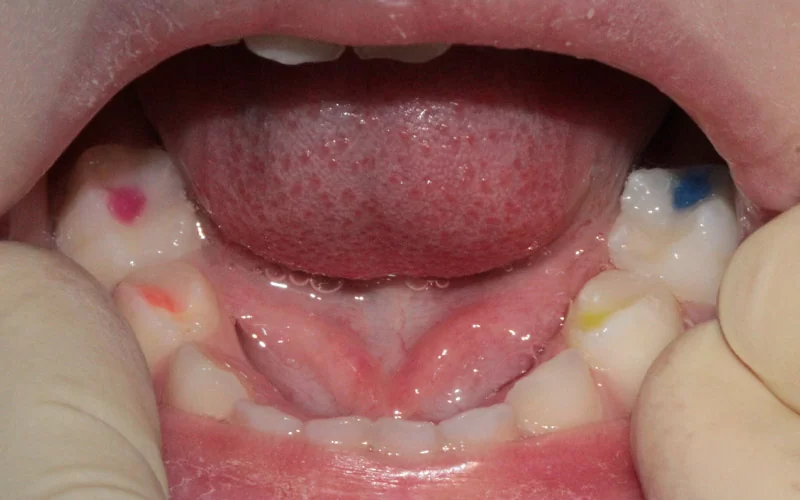 Лечение нижних молочных зубов. Цветные пломбы Twinky Star