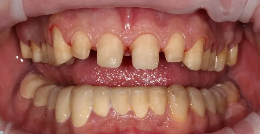 Ваш Стоматолог Примеры работ Поволоцкий Виниры Подготовка к протезированию винирами Обточка зубов