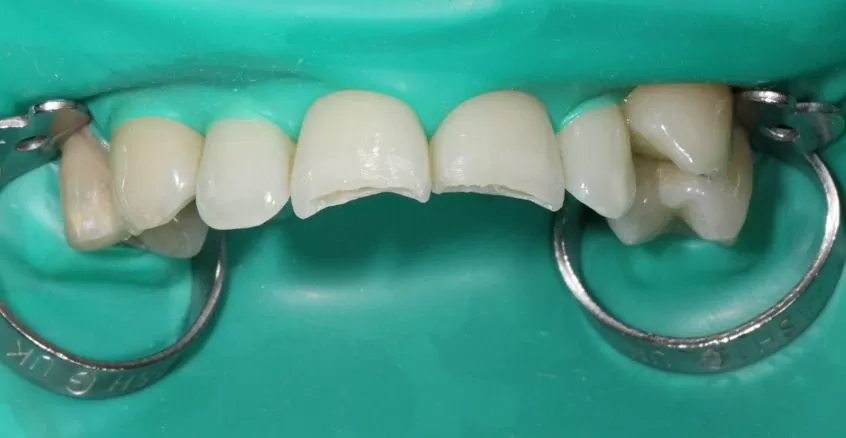 Изоляция рабочего поля и препарирование зубов