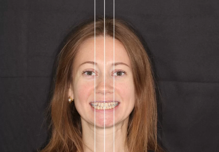 рис.2 совмещение положения зубов относительно лицевых паораметров.jpg