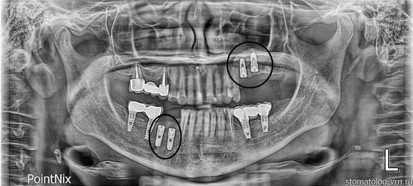 Контрольный снимок имплантатов в позиции 44,45. На верхней челюсти ранее поставлены имплантаты Osstem.