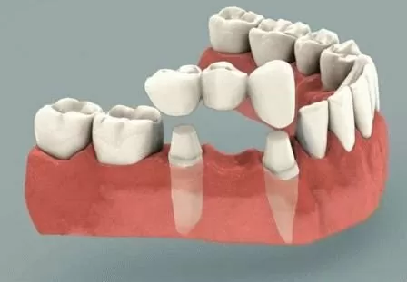 С помощью моста можно заменить один отсутствующий зуб.