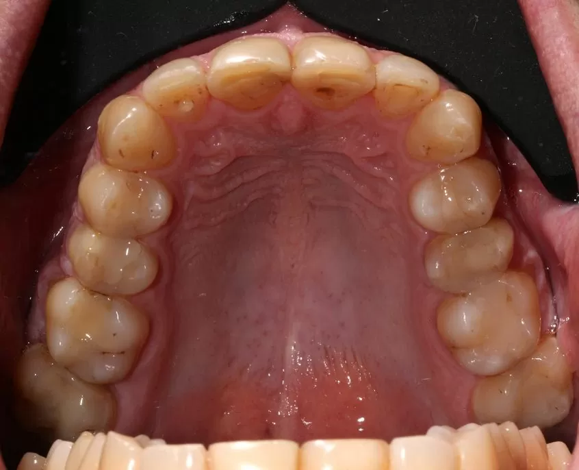 Ваш Стоматолог Примеры работ Поволоцкий Виниры Исходное состояние верхней челюсти