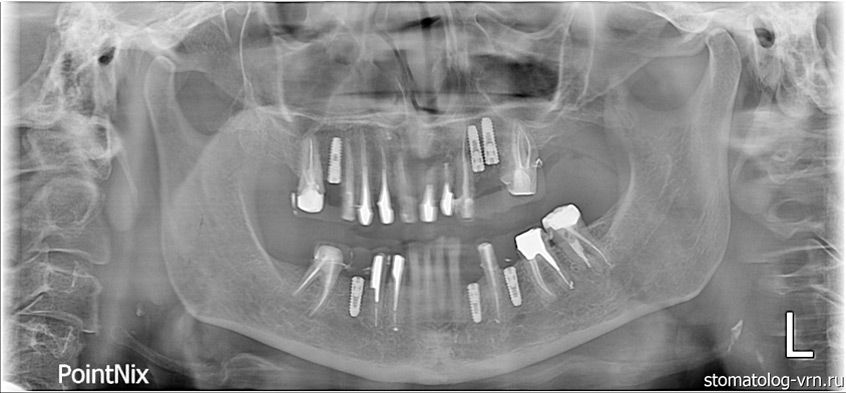 Ваш Стоматолог. Портфолио. Поволоцкий: Протезирование и имплантация. Снимок после имплантации в верхней челюсти.