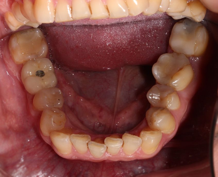 Ваш Стоматолог Примеры работ Поволоцкий Виниры Исходное состояние нижней челюсти