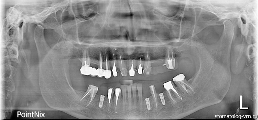 Ваш Стоматолог. Портфолио. Поволоцкий: Протезирование и имплантация. Снимок после имплантации на нижней челюсти