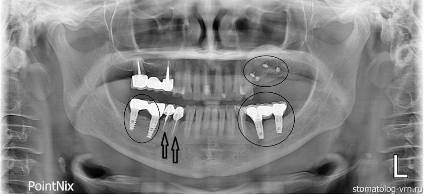 Стрелками помечены зубы, которые беспокоят. Белые точки на верхней челюсти — это пины для фиксации мембраны. На нижней челюсти помечены имплантаты, поставленные ранее.