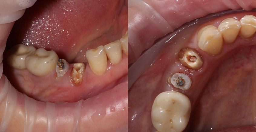 Фото зубов после снятия коронок и диагностического препарирования. Вид сбоку и сверху.