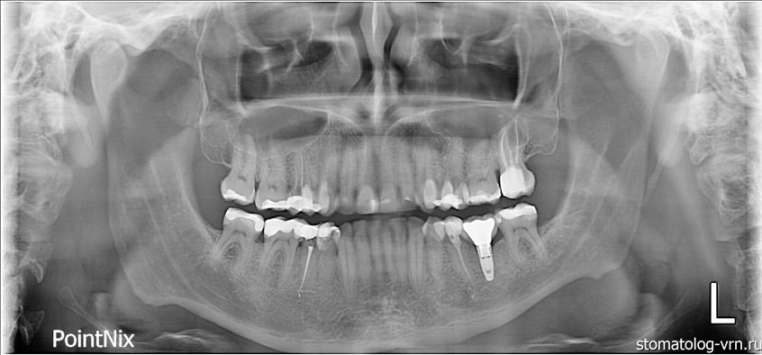 Ваш Стоматолог Примеры работ Поволоцкий Компьютерная 3D томограмма после терапевтических работ